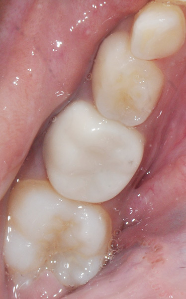 Zirconia Crown