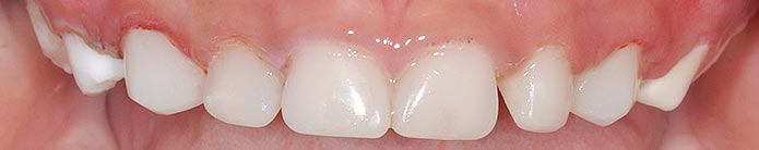 Zirconia Crown